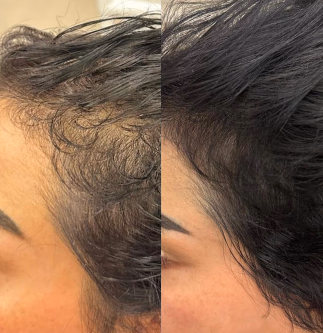 PRP plasmateraapia juustele