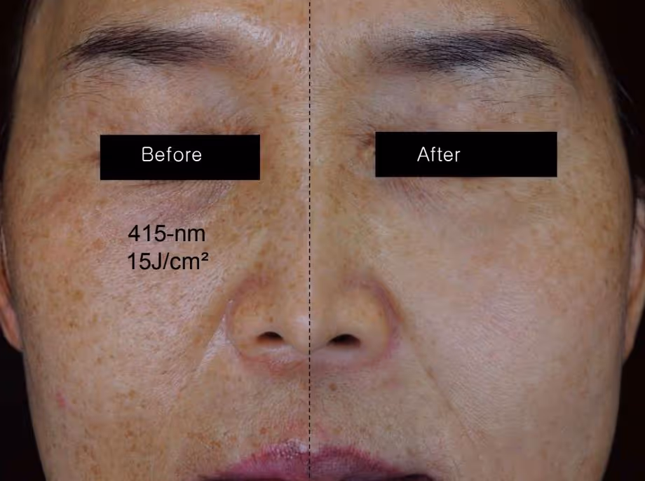 SOLRAY IPL - näide 1