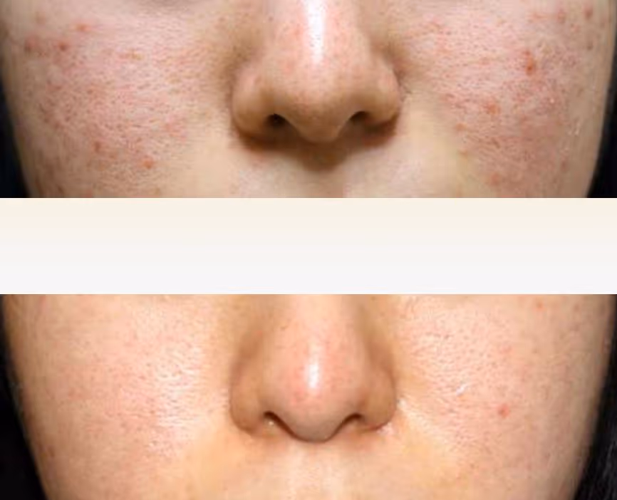 SOLRAY IPL - näide 2