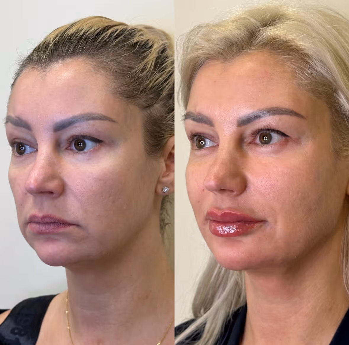 näoniidid, täitesüstid, särav ja pinguldatud nahk kiire tulemusega, MINT Lift näoniidid, Teoxane täitesüstid