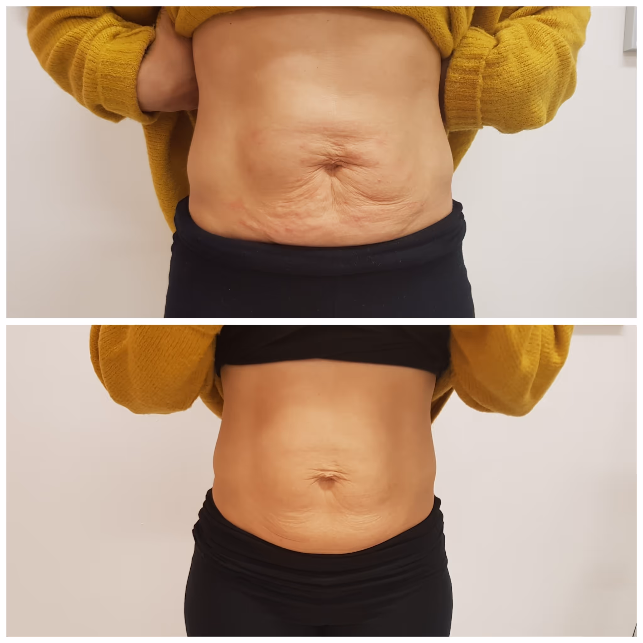 Näohooldused - Image Wrinkle Lift Forte