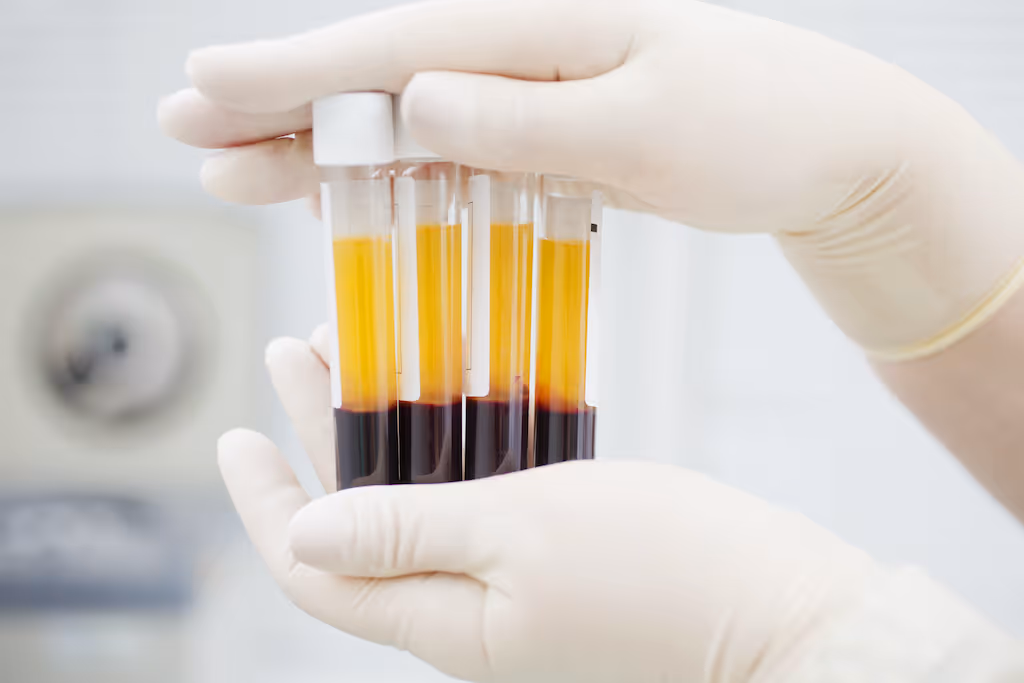 PRP Plasmateraapia