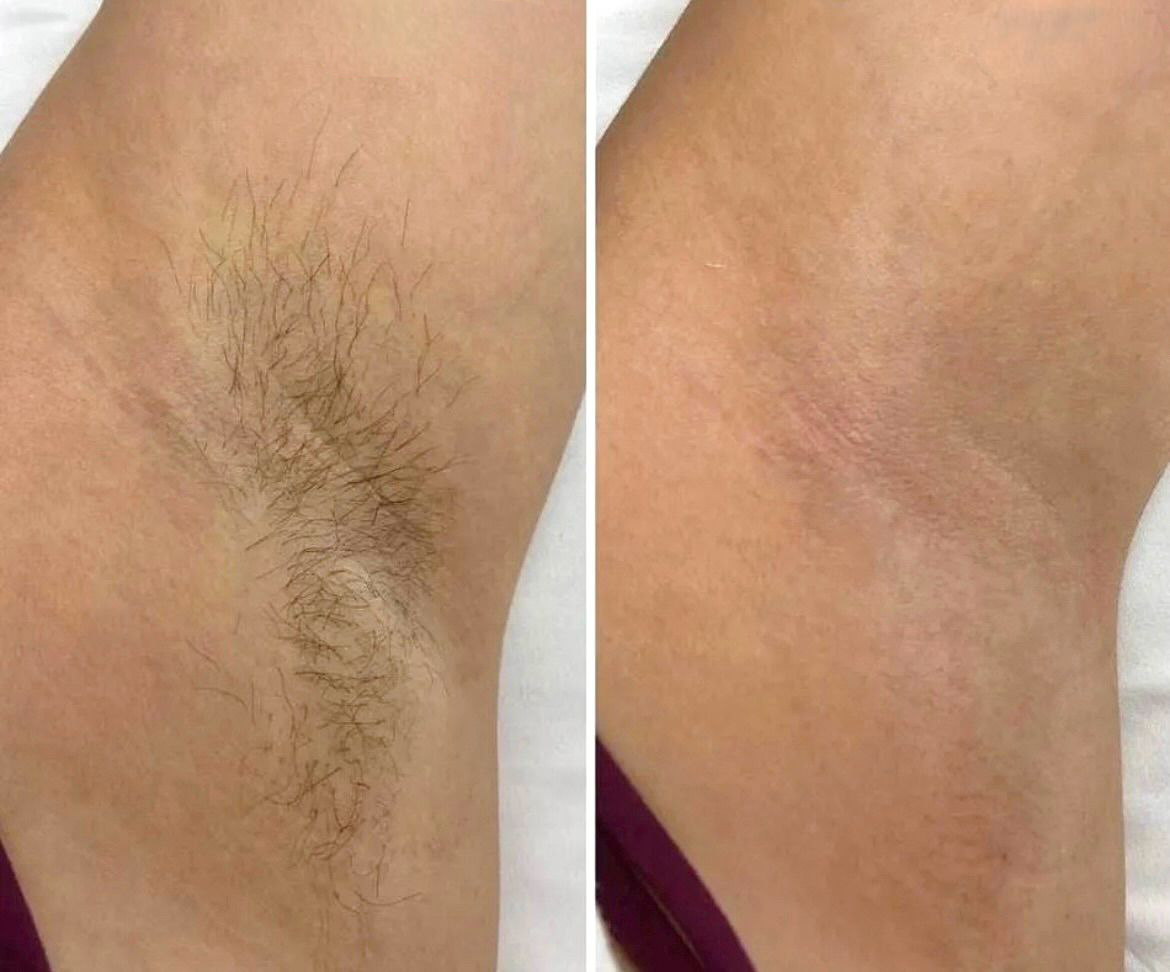 SOLARY IPL karvaeemaldus - tõhus ja pikaajaline lahendus sileda naha jaoks